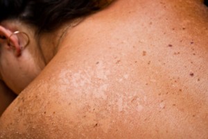 treat sun damaged skin in Zionsville IN