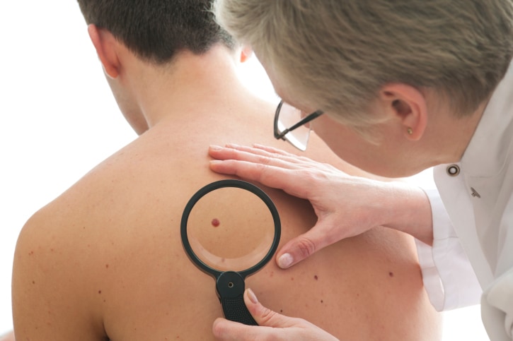 Moles and Why You Should See a Dermatologist