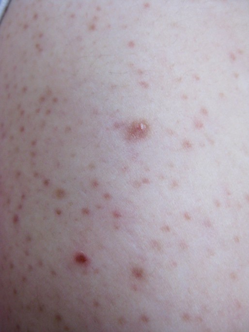 Treatment Scabies | The Dermatology Center Of Indiana