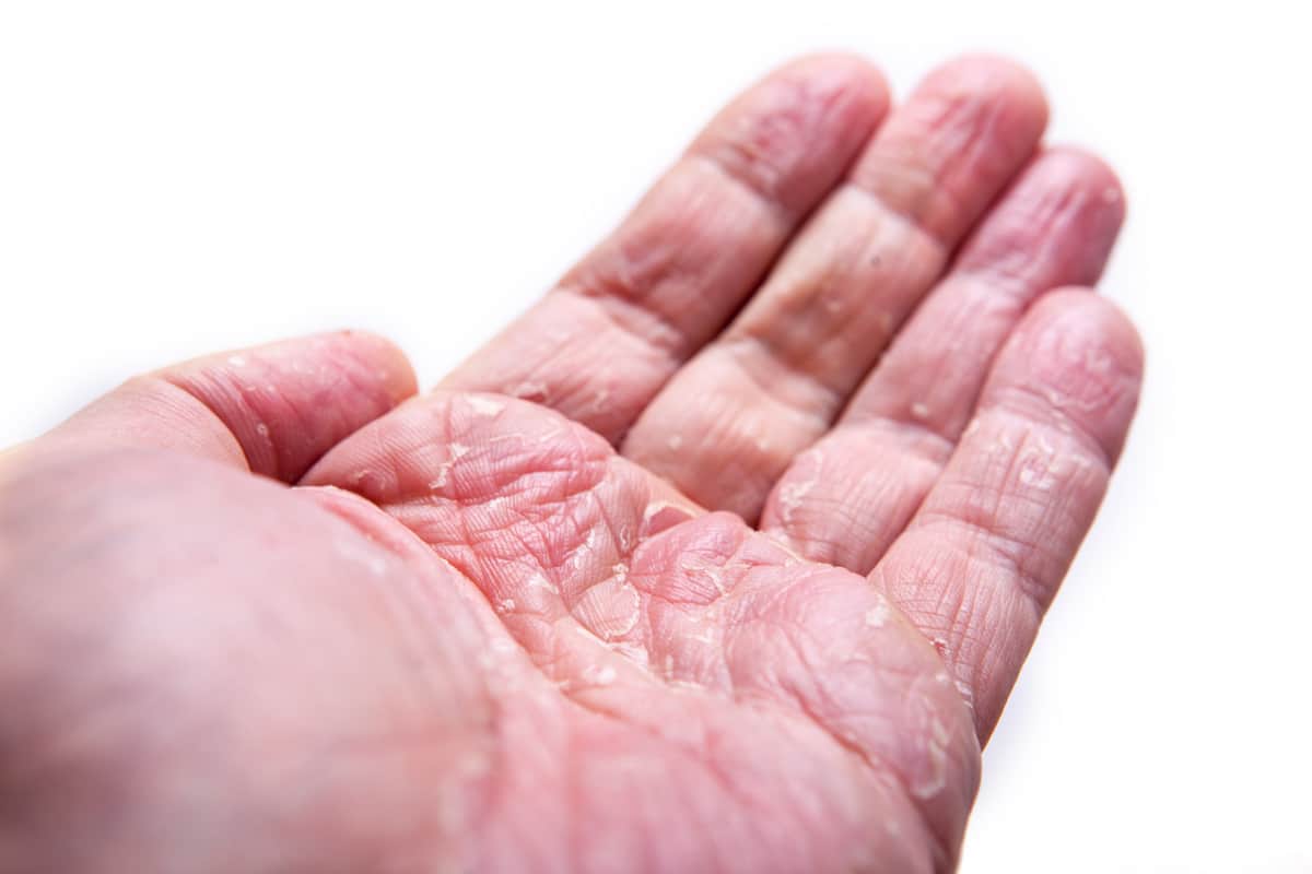 Controlling Hand Eczema at Home