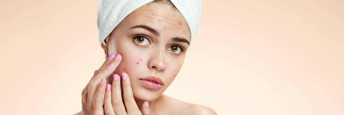 Acne: Types, Causes, and Treatment Options