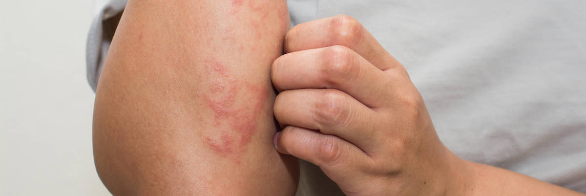 Psoriasis Causes and Treatment – What You Need to Know