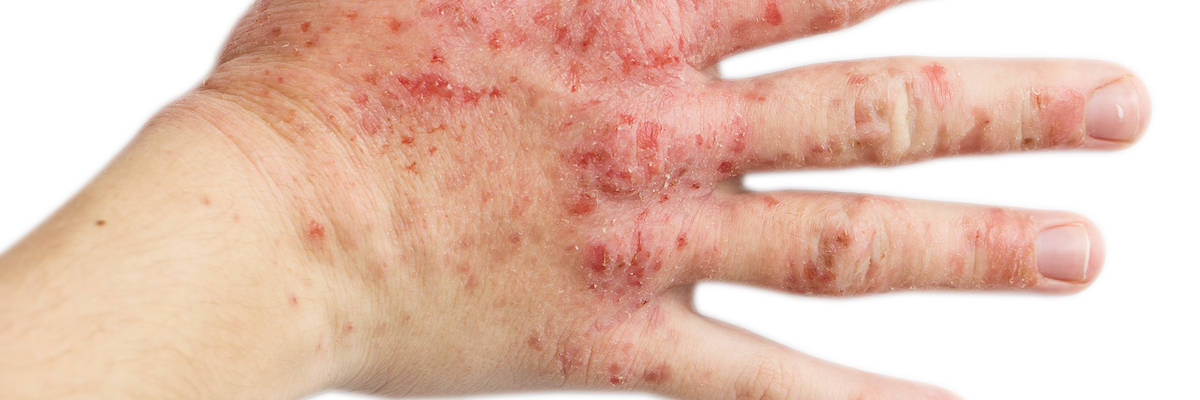 Hand Eczema And Dermatitis 2049