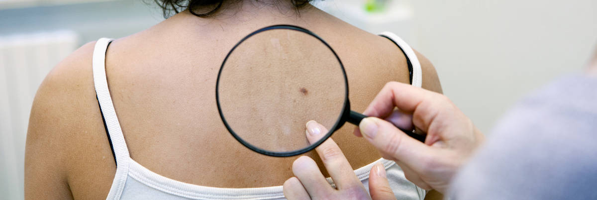 Skin Cancer and the Importance of Self and Medical Exams