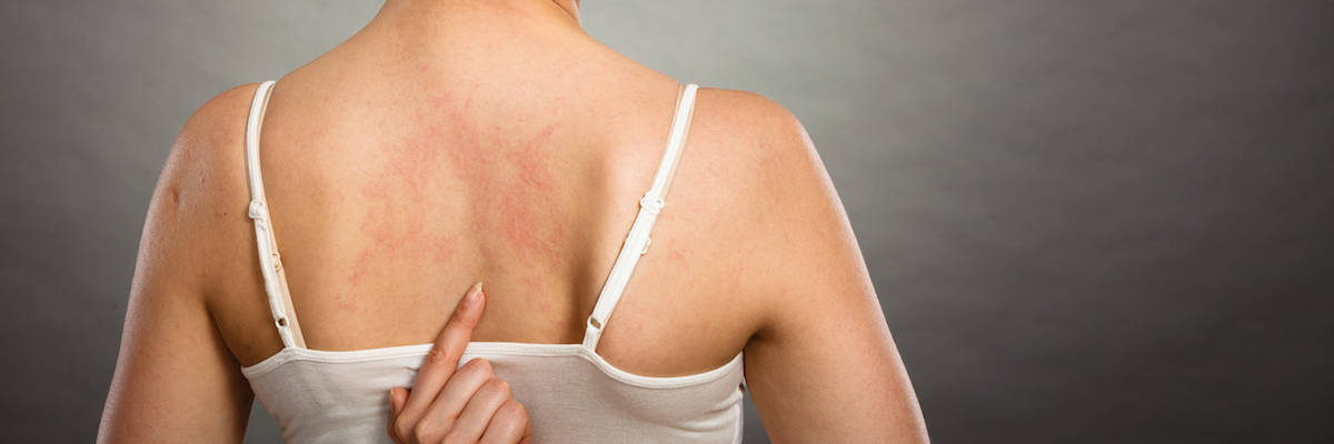 5 Top Causes of Skin Allergies