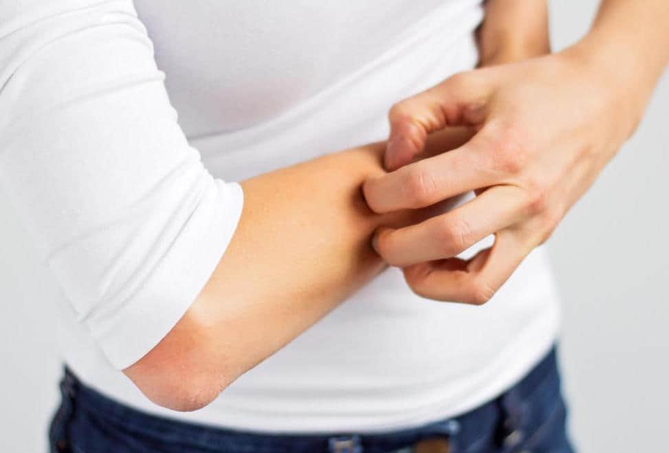 Tips for managing eczema