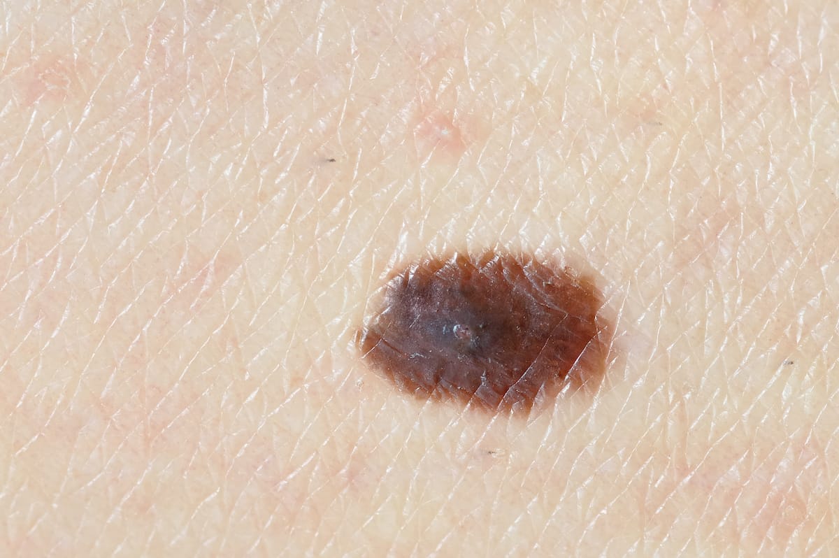 The Different Types of Skin Cancer