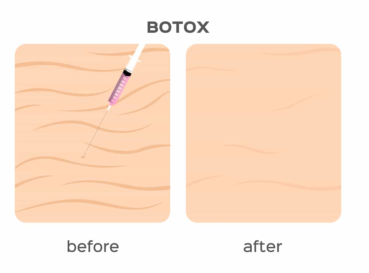 How Does Botox Work? The Dermatology Center of Indiana