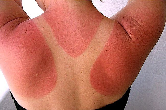 sunburn peeling back