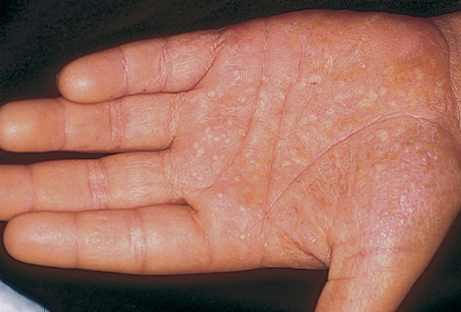 palmoplantar pustulosis vs pustular psoriasis vörös foltok jelentek meg a kézen és viszkető fotó