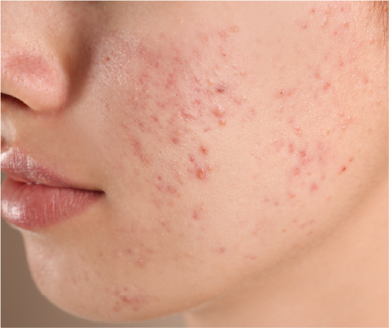 Acne