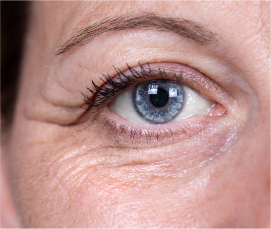 Crows Feet Lines