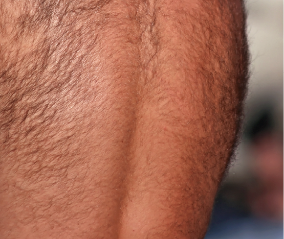 Excess Hair