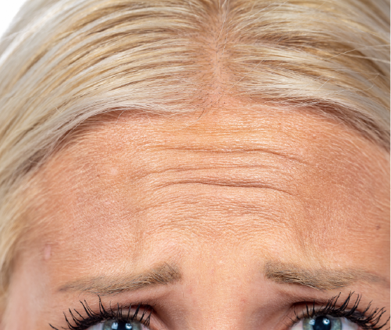 Forehead Lines