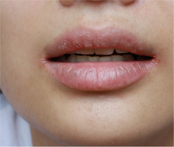 Lip Appearance & Texture