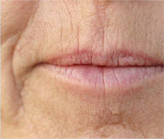 Lines & Wrinkles Around the Nose & Mouth