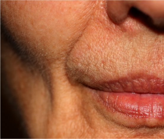 Flattened/Sunken Cheeks