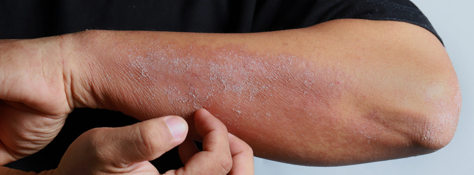 Winter Eczema How To Prevent Flare Ups The Dermatology Center Of Indiana