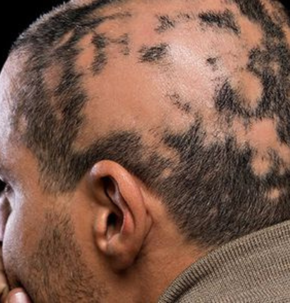 Alopecia Areata | The Dermatology Center Of Indiana